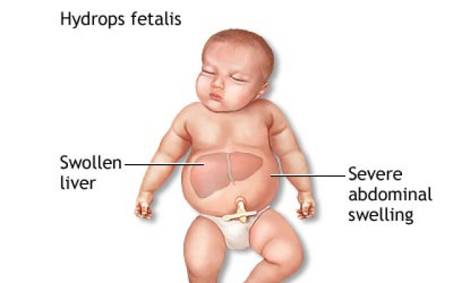Hydrops fetalis