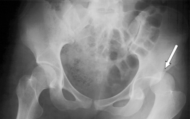 Posterior dislocation of hip joint 