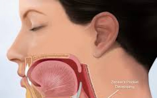 Zenker's diverticulum 