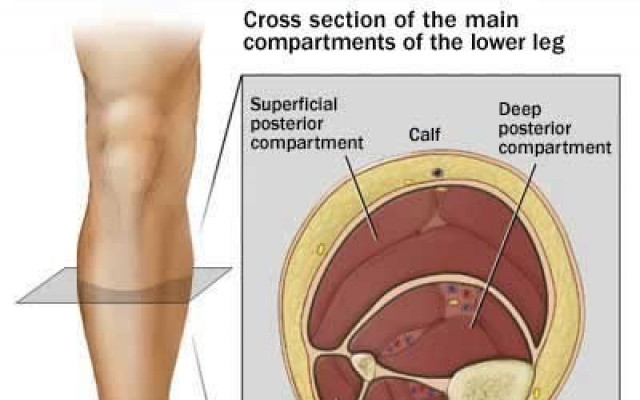compartment syndrome